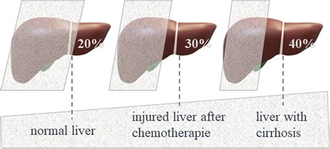 Future Remnant Liver Function 